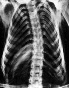 Radiografía torácica de Santa Rosa de Viterbo.