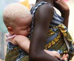 Los albinos en varios países africanos son asesinados o mutilados para vender partes de sus cuerpos para brujería