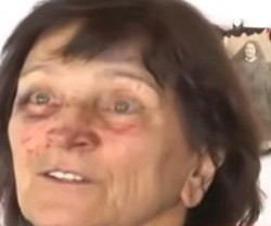 Una de las hermanas asaltadas con las heridas de los golpes en la cara