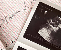 Cardiograma con información de los latidos del corazón de un bebé