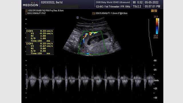 Latido del corazón de un feto en el primer trimestre de embarazo.