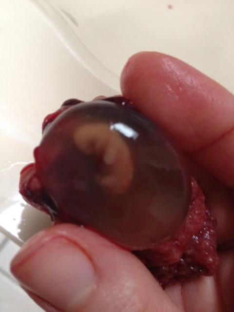 Una Madre Hace Viral La Foto De Su Hijo El Embrion De 7 Semanas Producto De Su Aborto Espontaneo Rel